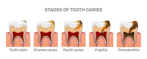 what damages tooth enamel